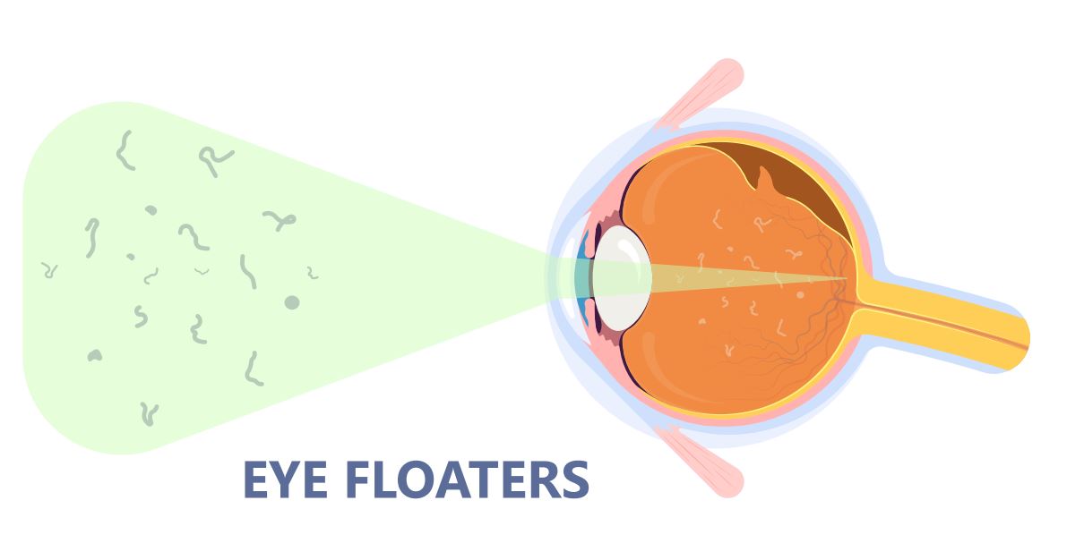 Diagnosing and Treating Eye Floaters